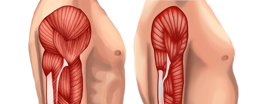 Age Related Loss of Muscle-How Can we Stop This?