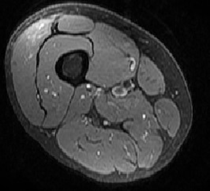 Age Related Loss of Muscle-How Can we Stop This?