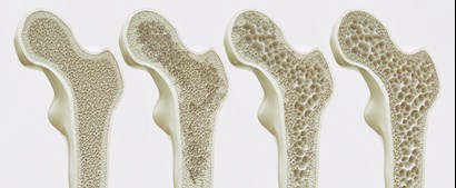 Why Bone Health is SO Important as we Age